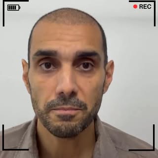 ✨ **𝗥𝗲𝗮𝗹 𝗣𝗮𝘁𝗶𝗲𝗻𝘁. 𝗥𝗲𝗮𝗹 𝗥𝗲𝘀𝘂𝗹𝘁𝘀.**

Two weeks after his hair transplant, **𝗠𝗮