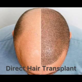 Direct Hair Transplant – Precision That Makes the Difference

At Neo Plant Advance Hair & Skin Clini