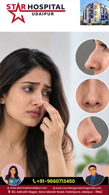 👃✨ Breathe Better. Feel More Confident.

Considering nose surgery? At Star Hospital Udaipur, get ex