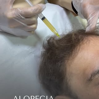 A base do tratamento do Diogo foi ciência e tecnologia. 

☑️MMP Capilar (Microinfusão de Medicamento