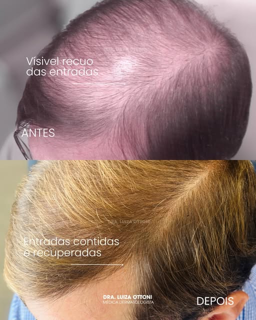 5 meses separam essas fotos. 
A disciplina somada a um diagnóstico médico correto, ciência e tecnolo