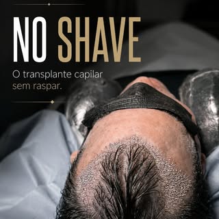 Nem todo transplante capilar exige raspar todo o cabelo.

A técnica No Shave permite realizar o proc