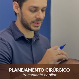 No transplante capilar, a distribuição dos folículos precisa seguir uma lógica técnica e estratégica