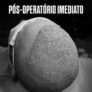 Alta densidade não significa simplesmente implantar o maior número possível de folículos em uma dete