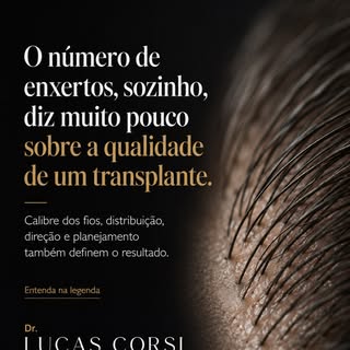 O número de enxertos, sozinho, não determina a qualidade de um transplante capilar.

É possível tran