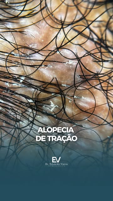 A alopecia de tração acontece quando o cabelo é submetido repetidamente a tensão, especialmente com 