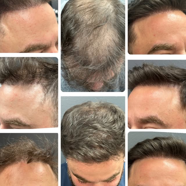 Every angle. Every area. Completely transformed.✨

These real FUE results from Dr. Stoller show what