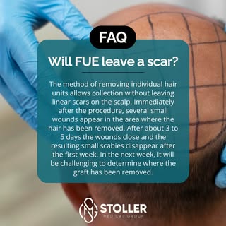FAQ: Will FUE Leave a Scar? 🔬

One of the most common questions we hear, and the answer is one of F