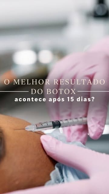 Você acha que o resultado do botox termina de aparecer aos 15 dias?

No consultório, sempre mostramo