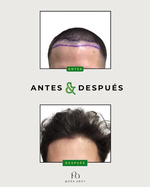 Un injerto capilar bien realizado no solo recupera cabello: devuelve armonía, confianza y naturalida