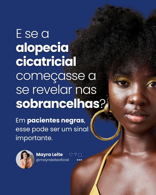 Vale a pena salvar esse post.

📚Referências:

Diagnostic Clues to Frontal Fibrosing Alopecia in Pat
