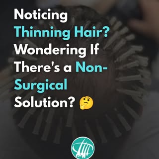 🌱 Scalp Thread Therapy – A New Approach to Hair Restoration

Noticing your hair getting thinner? Yo