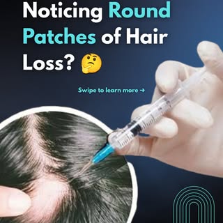 If you’ve noticed sudden, round patches of hair loss on your scalp or beard, it could be Alopecia Ar