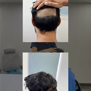 At just 27 years old, a receding hairline doesn’t have to define your confidence. 💇‍♂️

For this pa