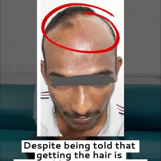 From losing his hair in a devastating fire accident to finding hope again. ❤️

Meet our patient, Kum