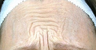 Swipe👉🏼 to see the amazing results of this beauties Xeomin Botox treatment done by our physician i