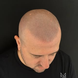 TRICOPIGMENTAZIONE Effetto rasato!
Un cambiamento visibile, un risultato che parla da solo. ✨

Quand