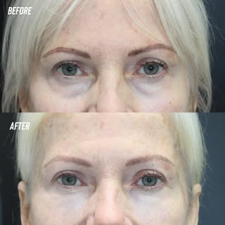 Before and after a small amount of Juvederm Volbella for infraorbital hollows. This result is 10 mon