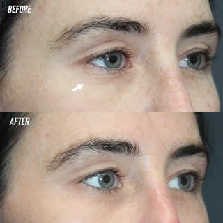 Before and 2 weeks after CO2 laser treatment for fine lines around the eyes. CO2 has been the gold s