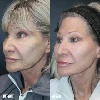 Love this Before and After following CO2 laser resurfacing with PRP for the whole face combined with