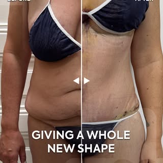Where lifted curves meet a newly defined waist. 💙

This tummy tuck and breast uplift transformed mo