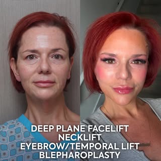 When every detail works together, youthfulness follows. ✨

Just eight weeks after surgery, this tran