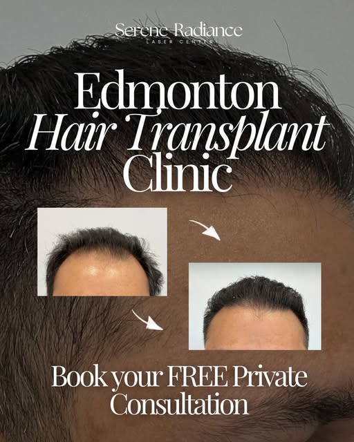 Looking for a Hair Transplant in the greater Edmonton area?

Using advanced techniques and personali