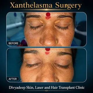 #divyadeepclinic
#xanthelasmaremoval 
#dermatosurgery