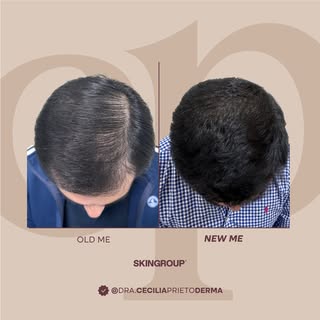 Mejorar la densidad del cabello es posible 👩🏻‍⚕️

Con el tratamiento indicado, la densidad y apari