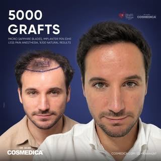 Natural looking hairline is achieved by planning carefully created micro irregularities and precisel