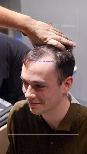 Natural looking hairline is achieved by creating carefully designed micro irregularities and precise