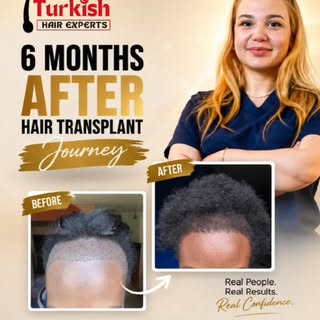 NONE SHAVE SAPPHIRE FUE HAIR TRANSPLANT

Just 6 months after her hair transplant, the transformation