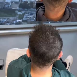 💥 Ramazan kampanyası
🎯 10 kişilik özel kontenjan
📍 İzmir’de profesyonel saç simülasyonu

Yeriniz 