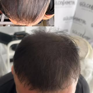 Avantajları:

* Doğal ve dolgun görünüm sağlar
* Cerrahi bir işlem değildir
* Günlük hayatı etkileme