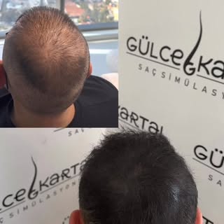 “Seyrek saç görünümü kader değil.
Saç simülasyonu ile saçlarınıza doğal bir yoğunluk kazandırıyoruz.