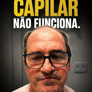 Falaram que Transplante Capilar não funciona, será?

O resultado começa a ser construído no dia da c