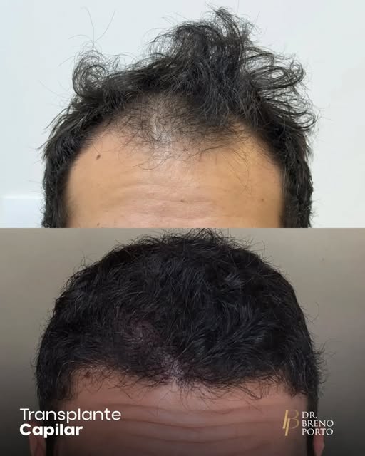 A evolução de um transplante capilar deve ser analisada por mais de um ângulo.

A linha frontal infl