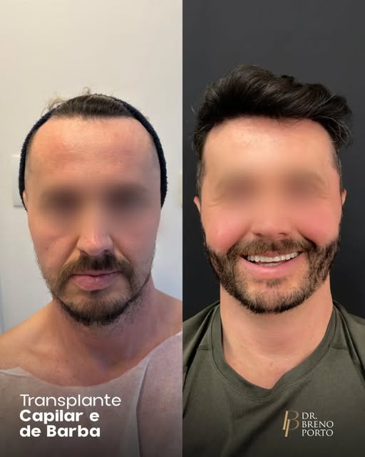 Cabelo e barba exigem estratégias diferentes.
No transplante capilar, direção, densidade e distribui