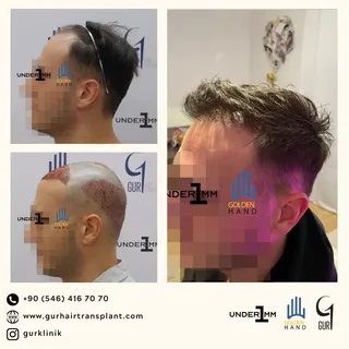 #drgur #drgokhangur #gurhairtransplant #hairtransplant #haartransplantation #fue #fuesurgery #fuesur