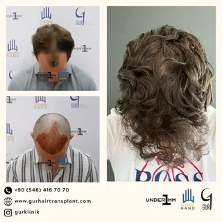 #drgur #drgokhangur #gurhairtransplant #hairtransplant #haartransplantation #fue #fuesurgery #fuesur