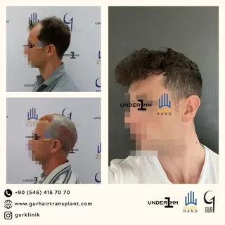 #drgur #drgokhangur #gurhairtransplant #hairtransplant #haartransplantation #fue #fuesurgery #fuesur