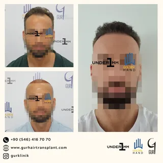 #drgur #drgokhangur #gurhairtransplant #hairtransplant #haartransplantation #fue #fuesurgery #fuesur