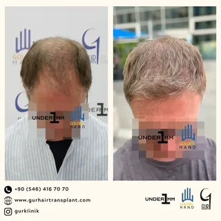 #drgur #drgokhangur #gurhairtransplant #hairtransplant #haartransplantation #fue #fuesurgery #fuesur