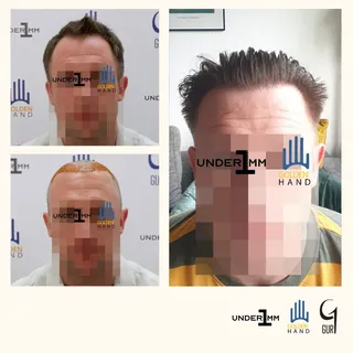 #drgur #drgokhangur #gurhairtransplant #hairtransplant #haartransplantation #fue #fuesurgery #fuesur