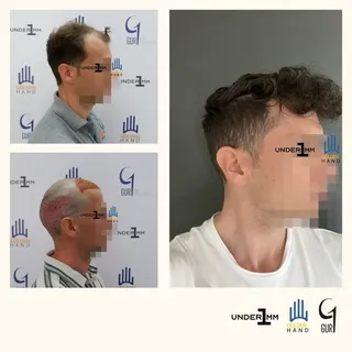 #drgur #drgokhangur #gurhairtransplant #hairtransplant #haartransplantation #fue #fuesurgery #fuesur