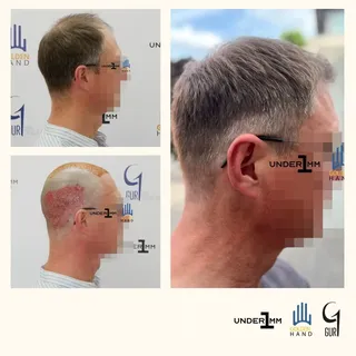 #drgur #drgokhangur #gurhairtransplant #hairtransplant #haartransplantation #fue #fuesurgery #fuesur