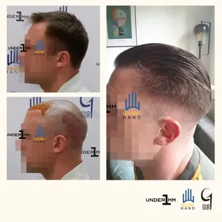 #drgur #drgokhangur #gurhairtransplant #hairtransplant #haartransplantation #fue #fuesurgery #fuesur