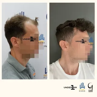 #drgur #drgokhangur #gurhairtransplant #hairtransplant #haartransplantation #fue #fuesurgery #fuesur