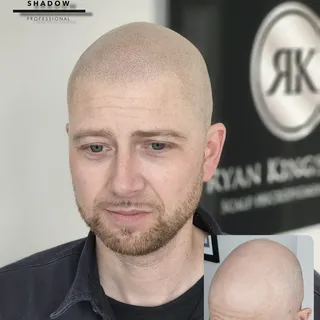 One month fully healed after 2 sessions.
New man with a new natural hairline after coming from a Nor