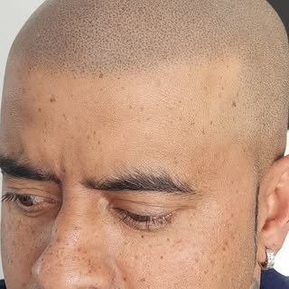 Soft, natural, undetectable.
Brand new man 🙏🏼❤️‍🔥

Get Hairline Confident.
𝑻𝒉𝒆 𝒘𝒐𝒓𝒍𝒅'𝒔 �